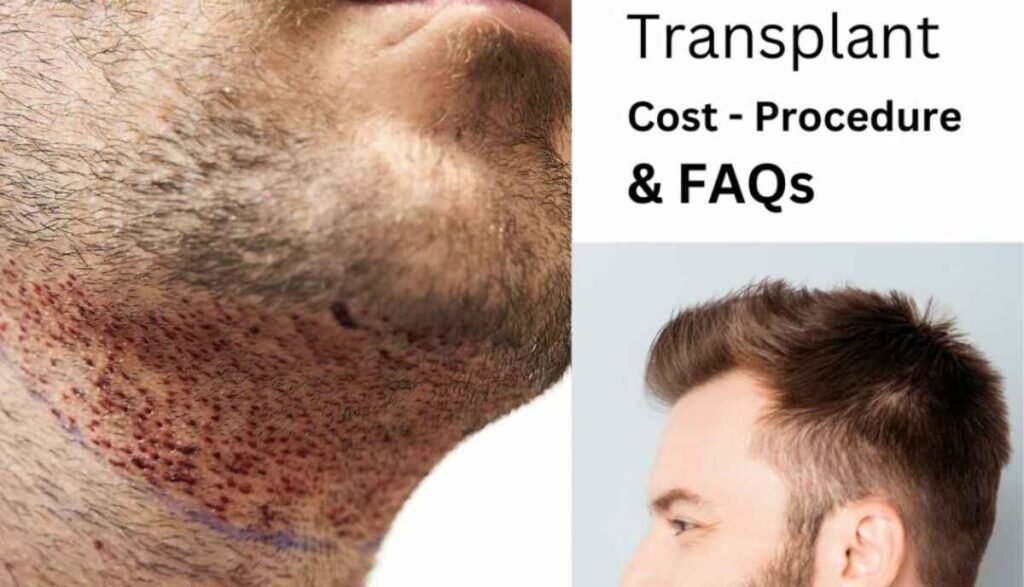 Beard vs. Mustache Transplants- Which Is Right for You